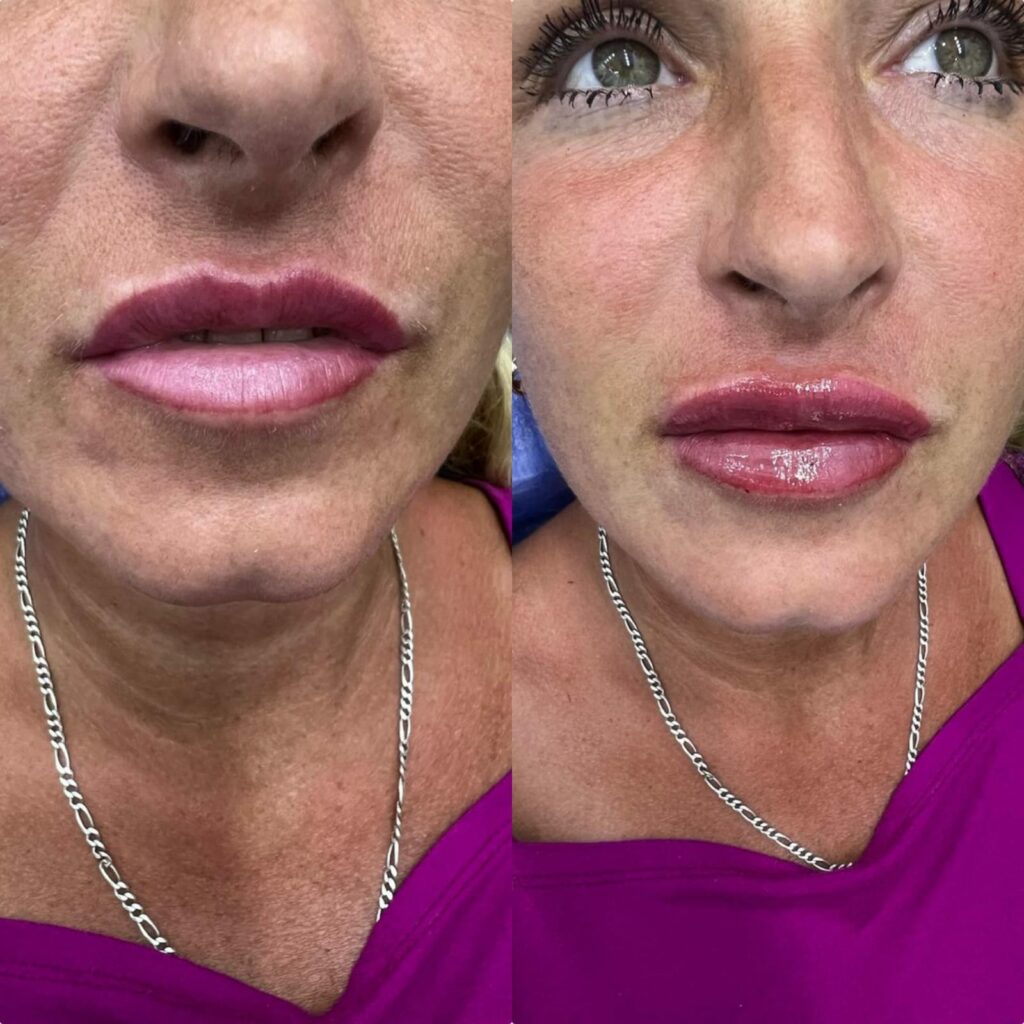 Lip augmentation with fillers